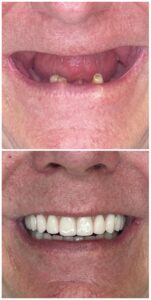 implanty zebowe w 1 dzien