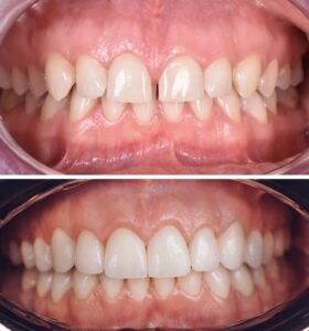 metamorfoza uśmiechu